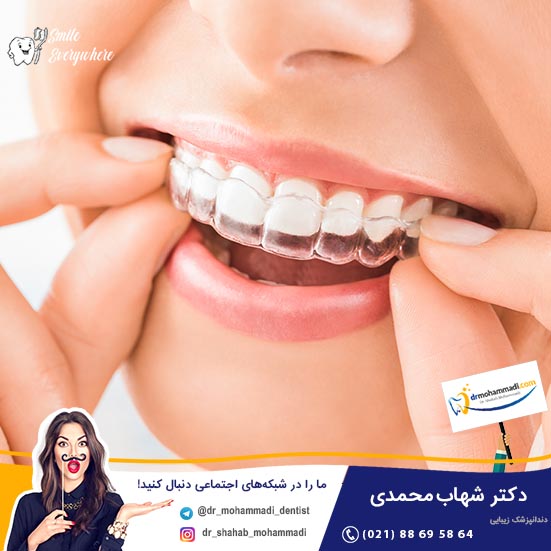 ارتودنسی نامرئی چیست و چه مزایایی دارد؟ - کلینیک دندانپزشکی دکتر شهاب محمدی